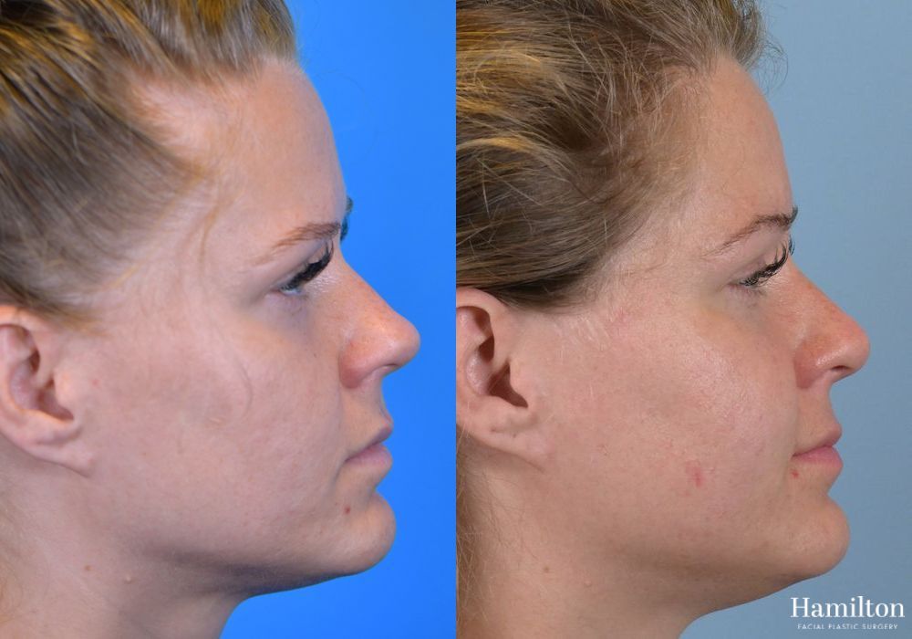 Before and after Rhinoplasty case 37359 - Angle 3