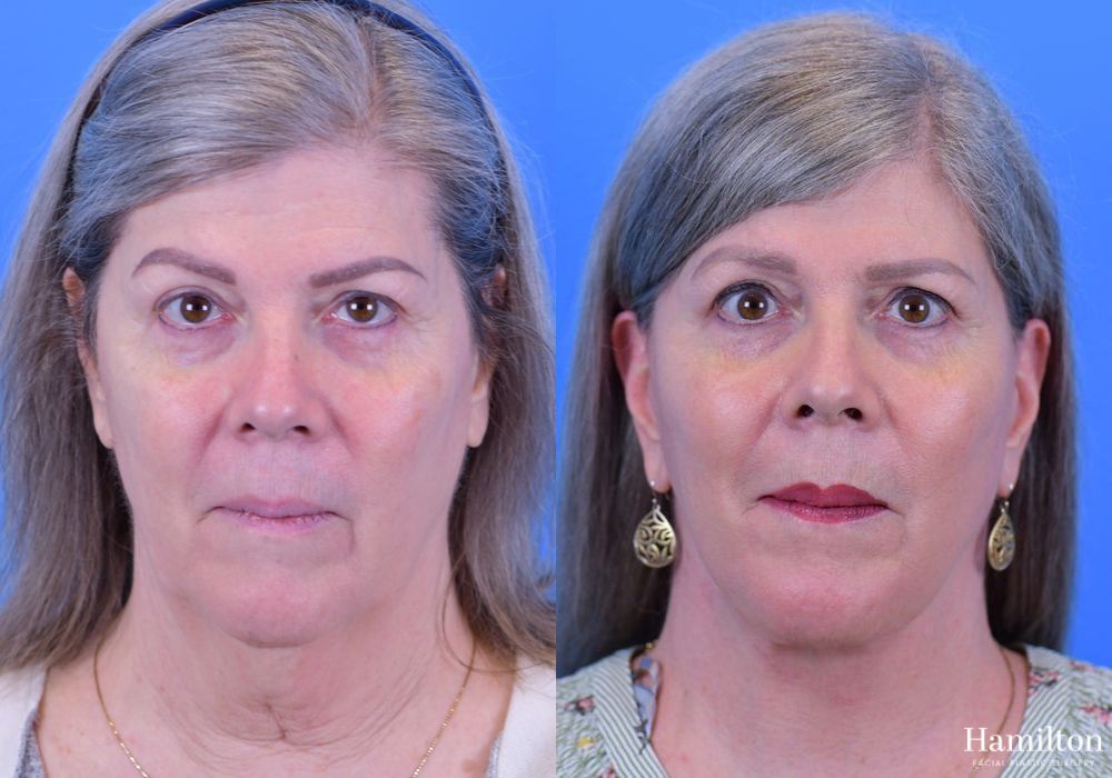 Before and after Facelift case 37278 - Angle 3
