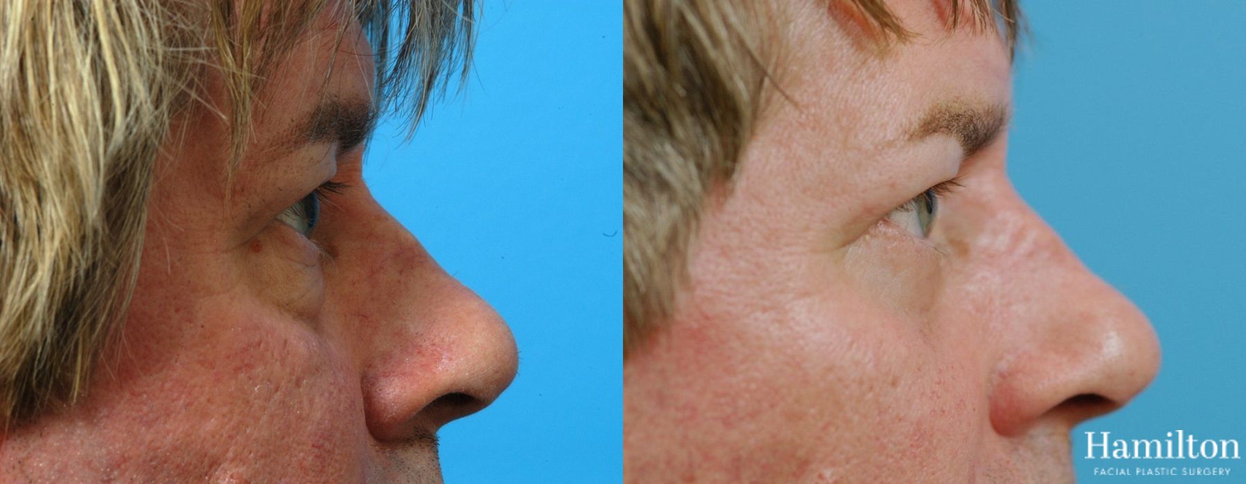 Before and after Blepharoplasty case 37309 - Angle 5