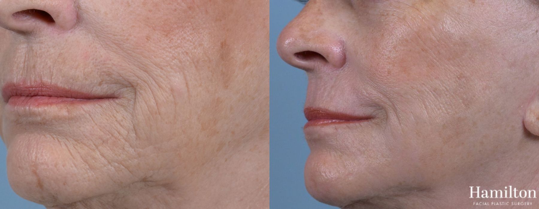 Before and after Laser - Sciton case 37118 - Angle 4