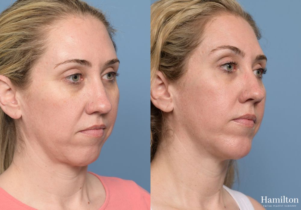 Before and after Chin Augmentation case 37179 - Angle 4