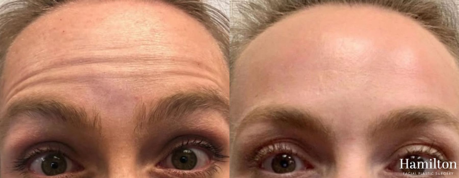 Before and after Neurotoxins/BOTOX case 37164