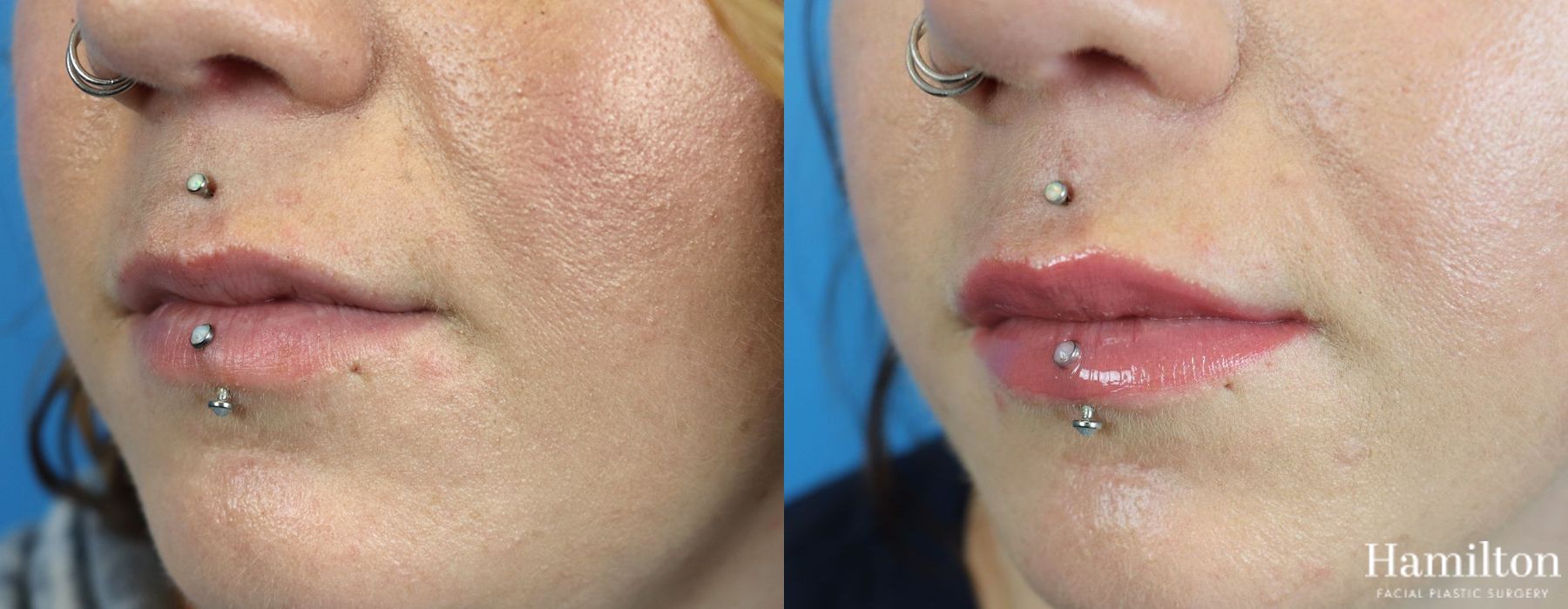 Before and after Lip Enhancement case 37190 - Angle 3
