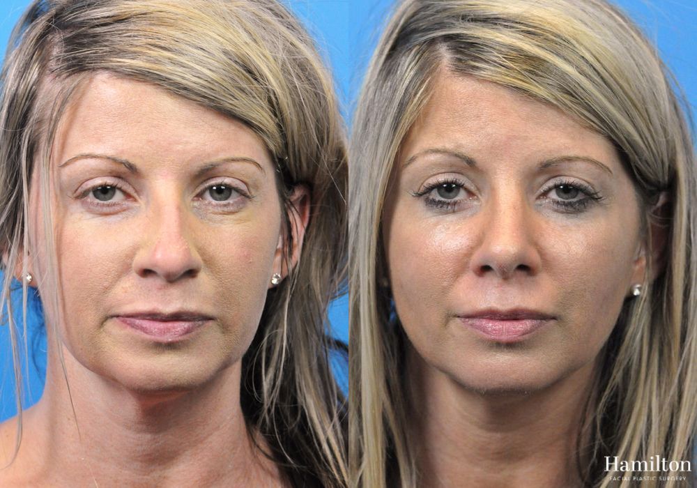 Before and after Rhinoplasty case 37334 - Angle 5