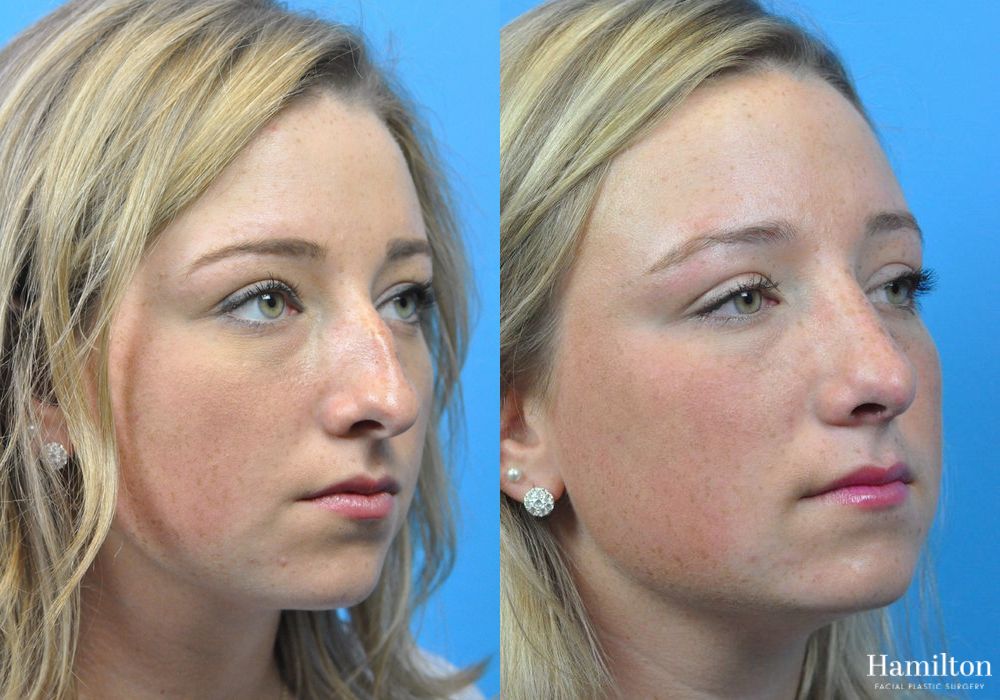 Before and after Rhinoplasty case 37328 - Angle 3