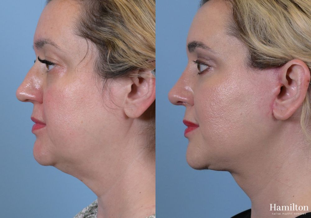 Before and after Facelift case 37138 - Angle 5