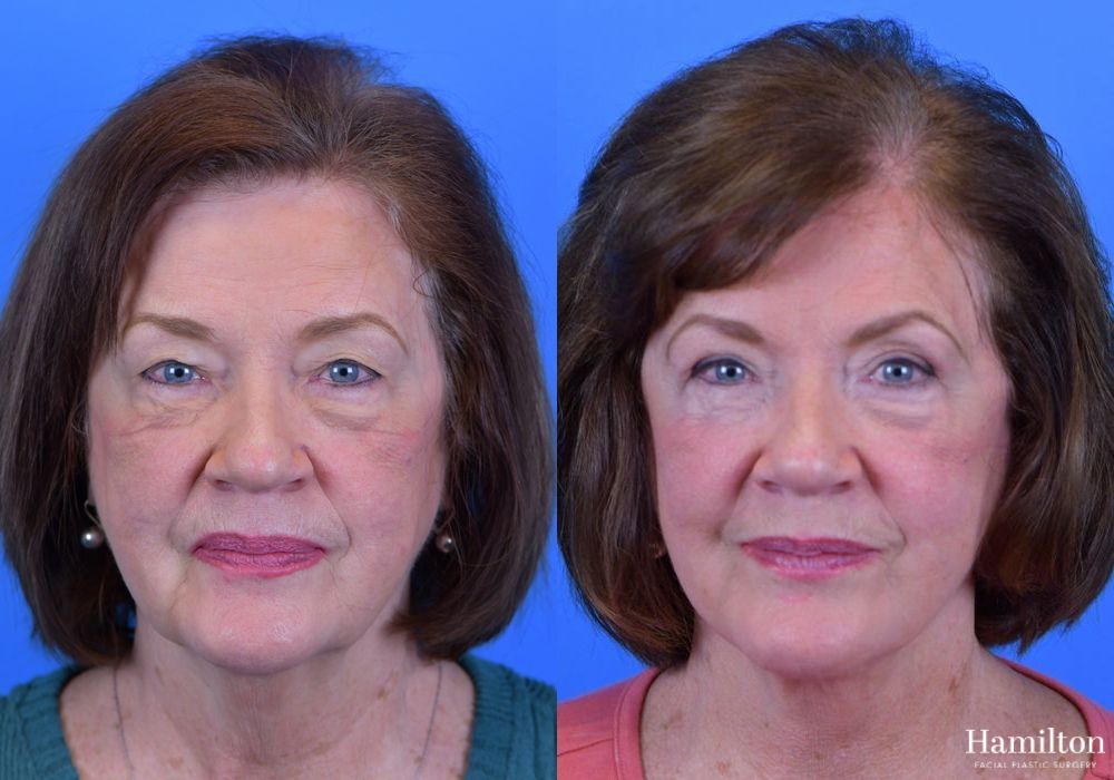 Before and after Facelift case 37291 - Angle 2