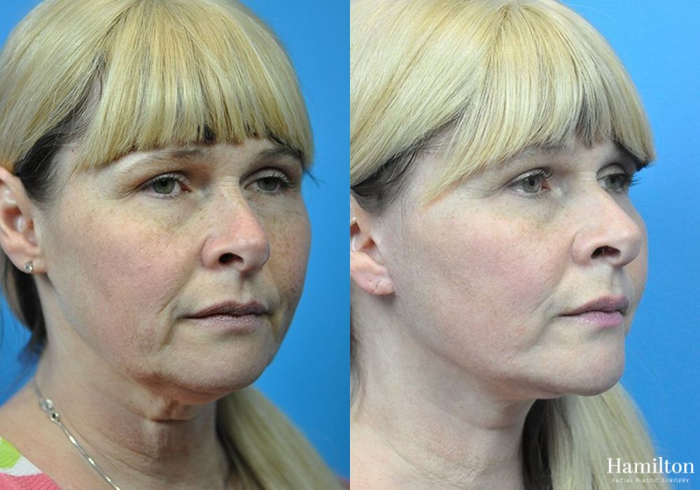Before and after Facelift case 37261