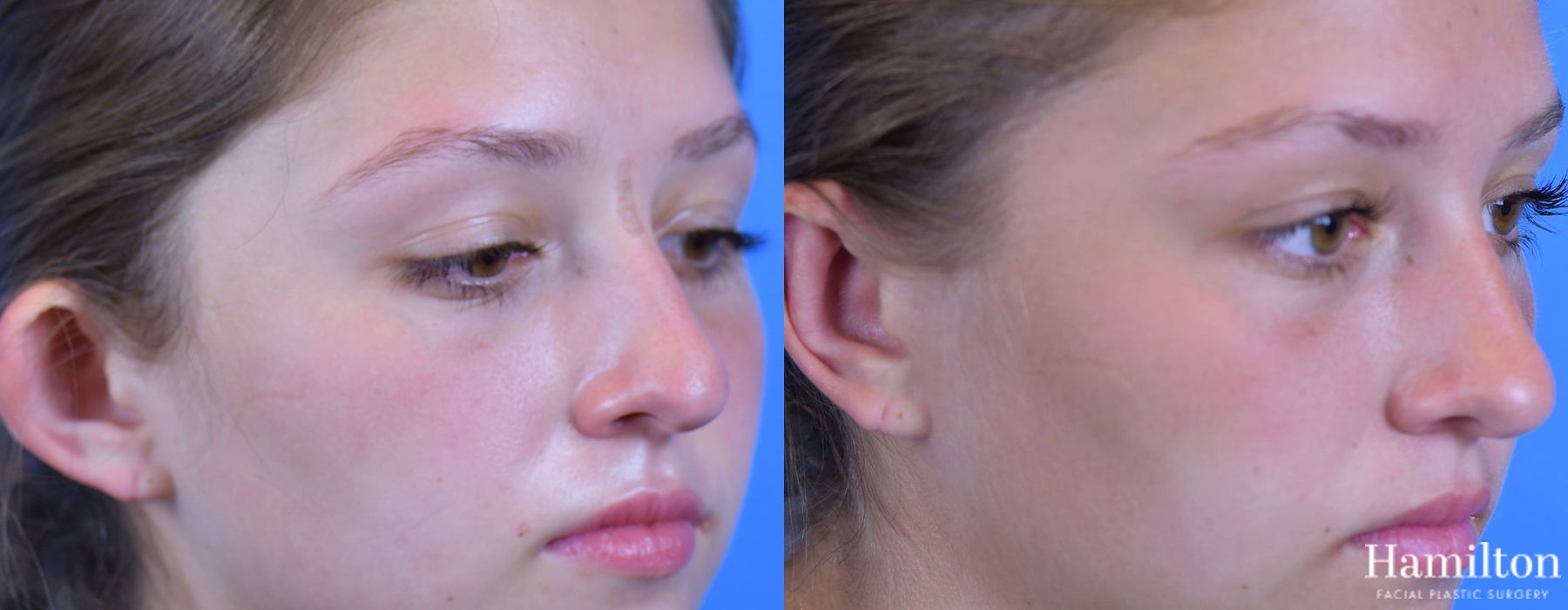 Before and after Otoplasty case 37093 - Angle 3