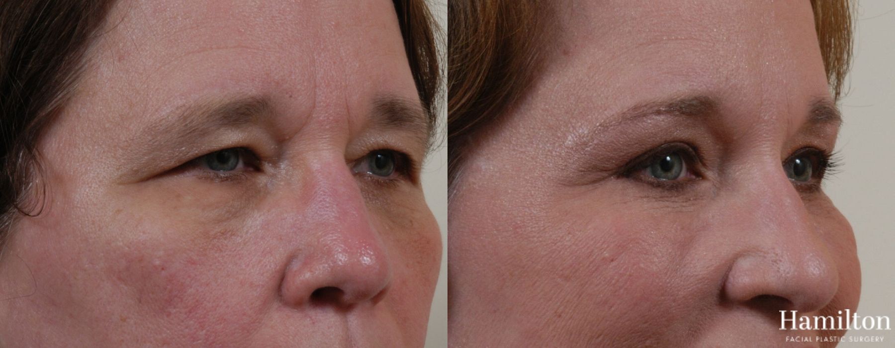 Before and after Blepharoplasty case 37270 - Angle 4
