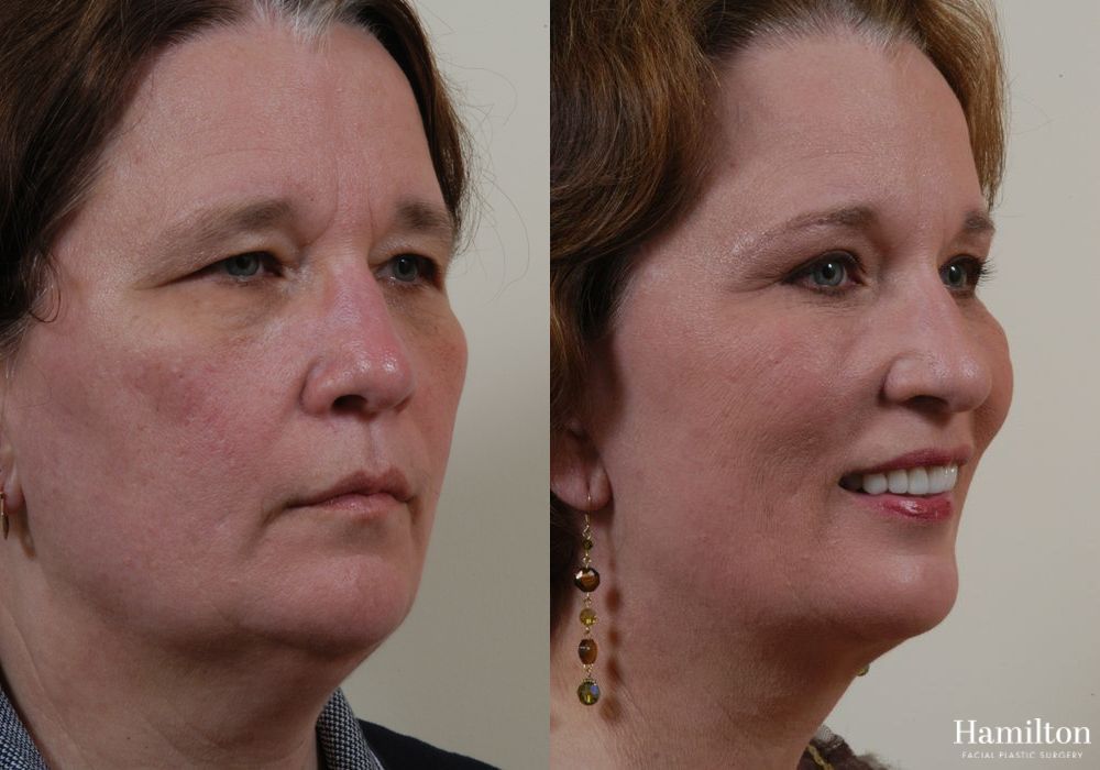 Before and after Facelift case 37265 - Angle 4