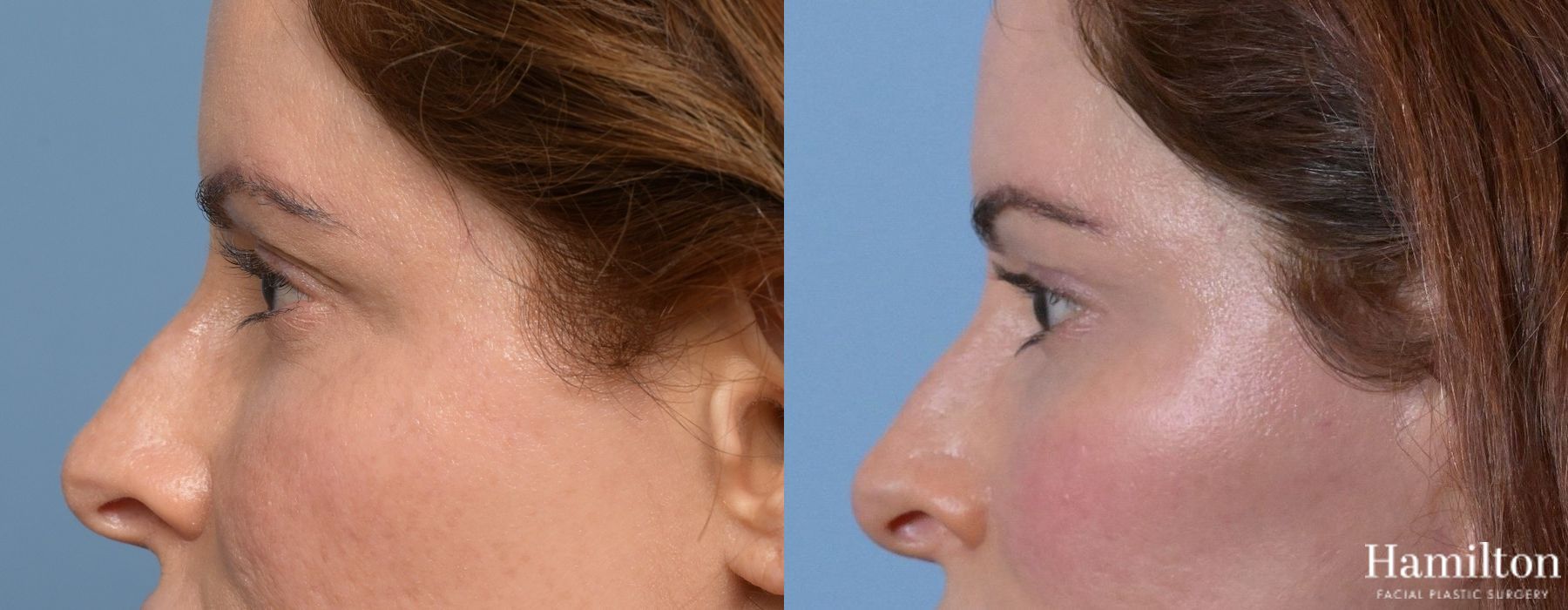 Before and after Blepharoplasty case 37169 - Angle 3