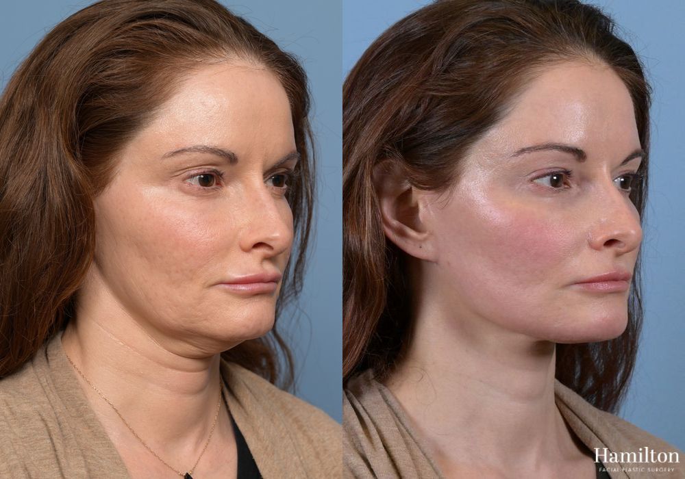 Before and after Neck Rejuvenation case 37096 - Angle 2