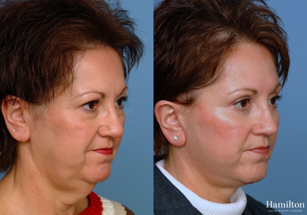 Before and after Facelift case 37283 - Angle 2