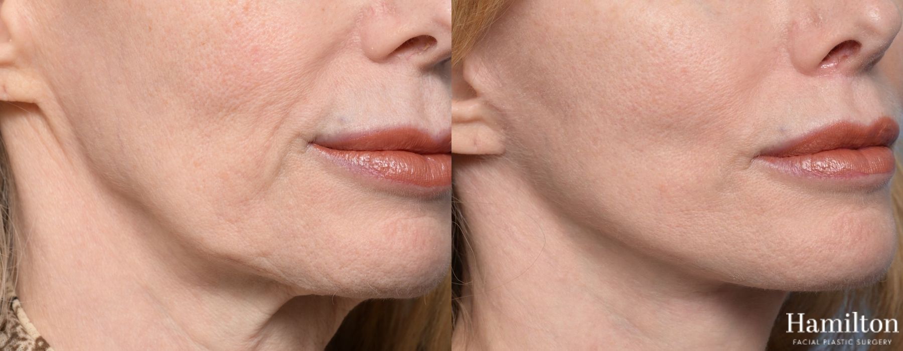 Before and after Lip Lift case 37100 - Angle 5