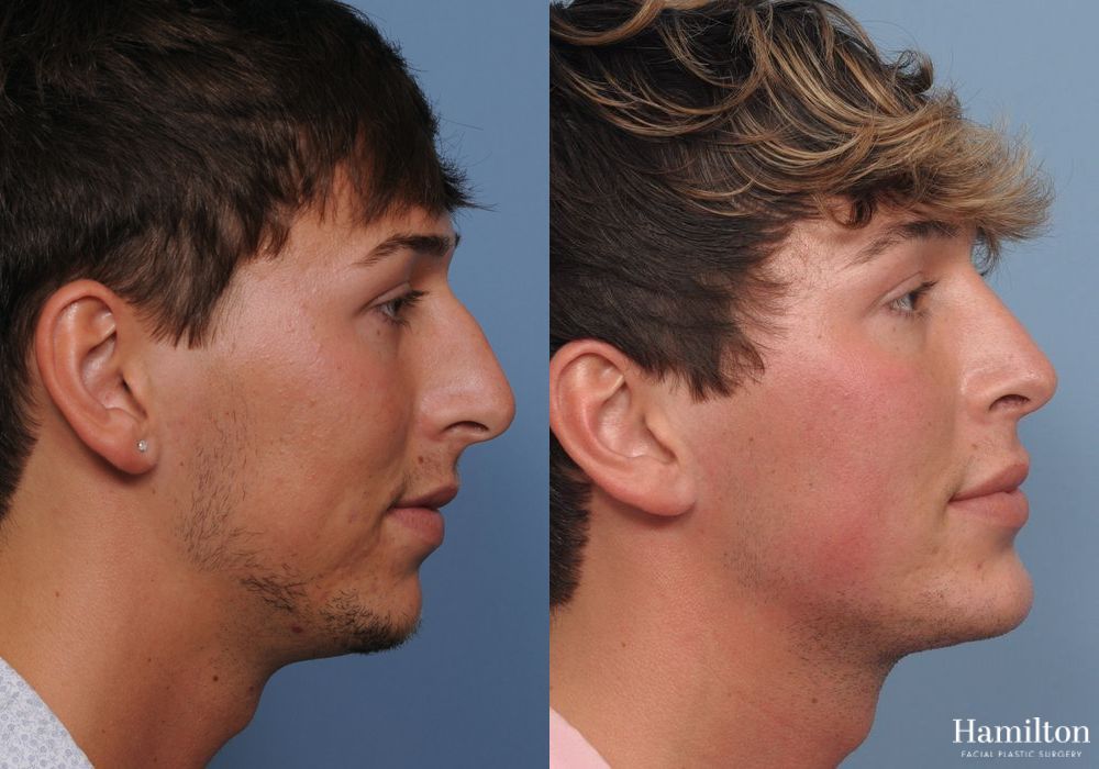 Before and after Rhinoplasty case 37293 - Angle 2