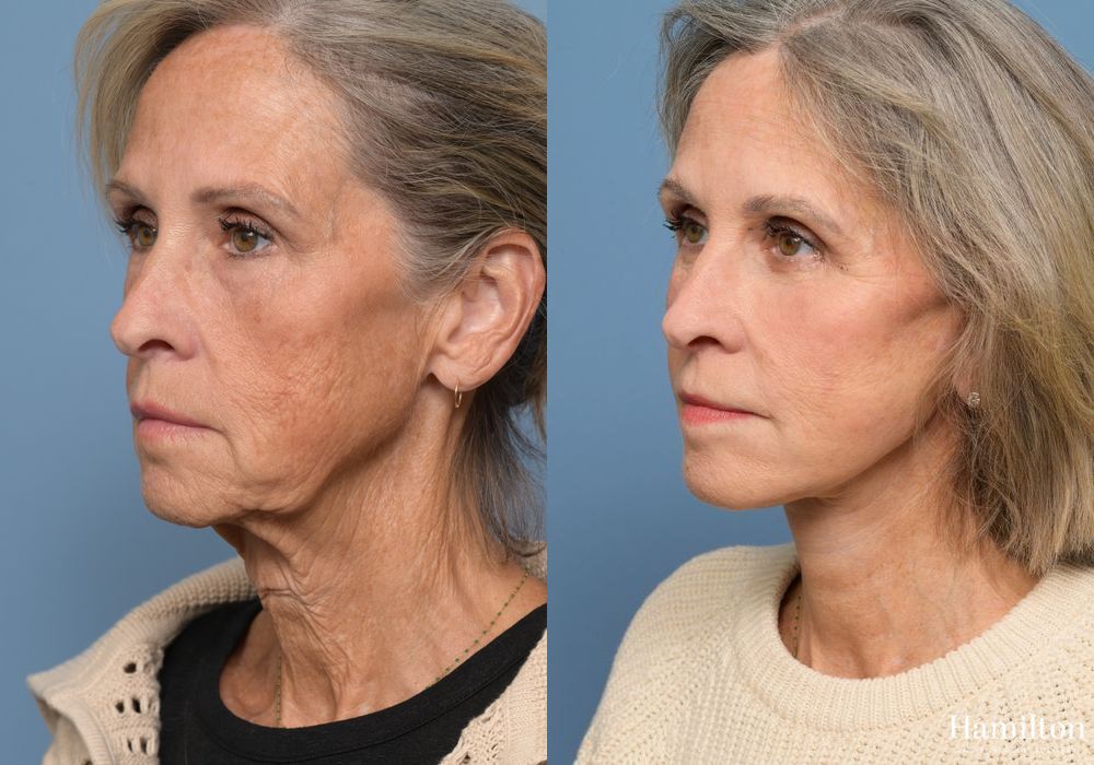 Before and after Facelift case 37219 - Angle 4