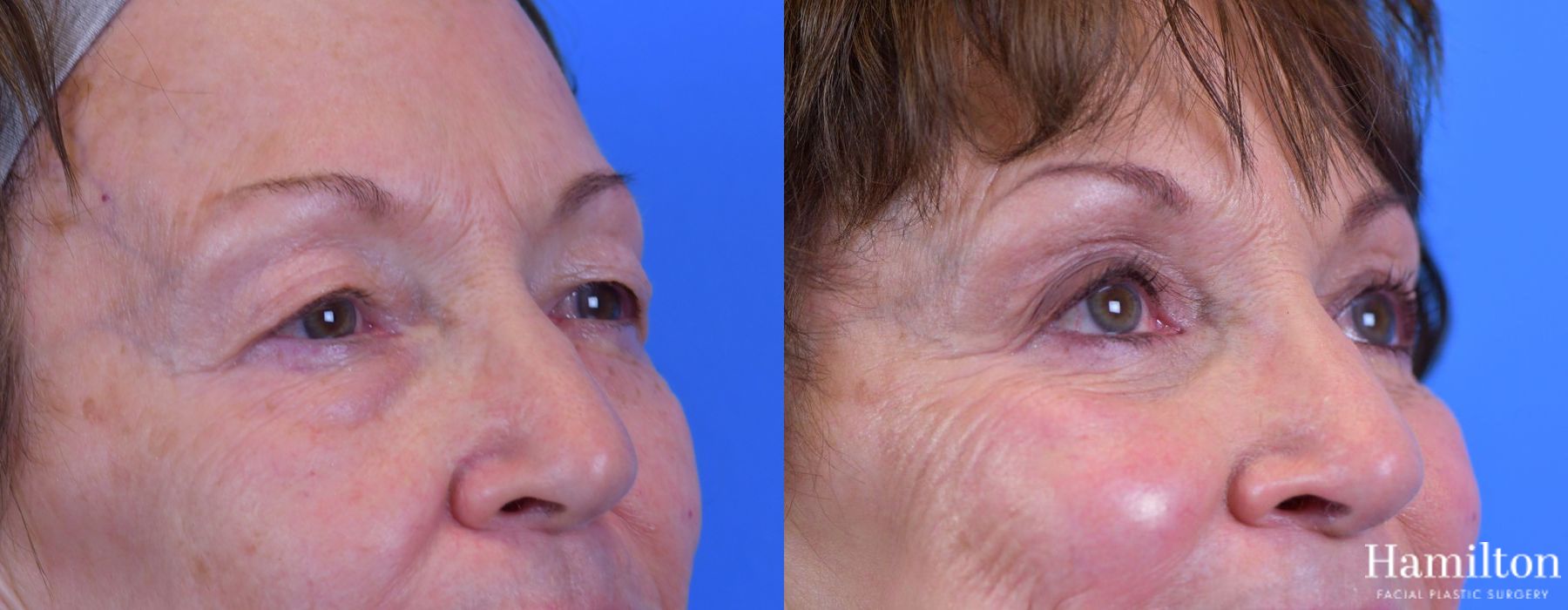 Before and after Blepharoplasty case 37297 - Angle 5