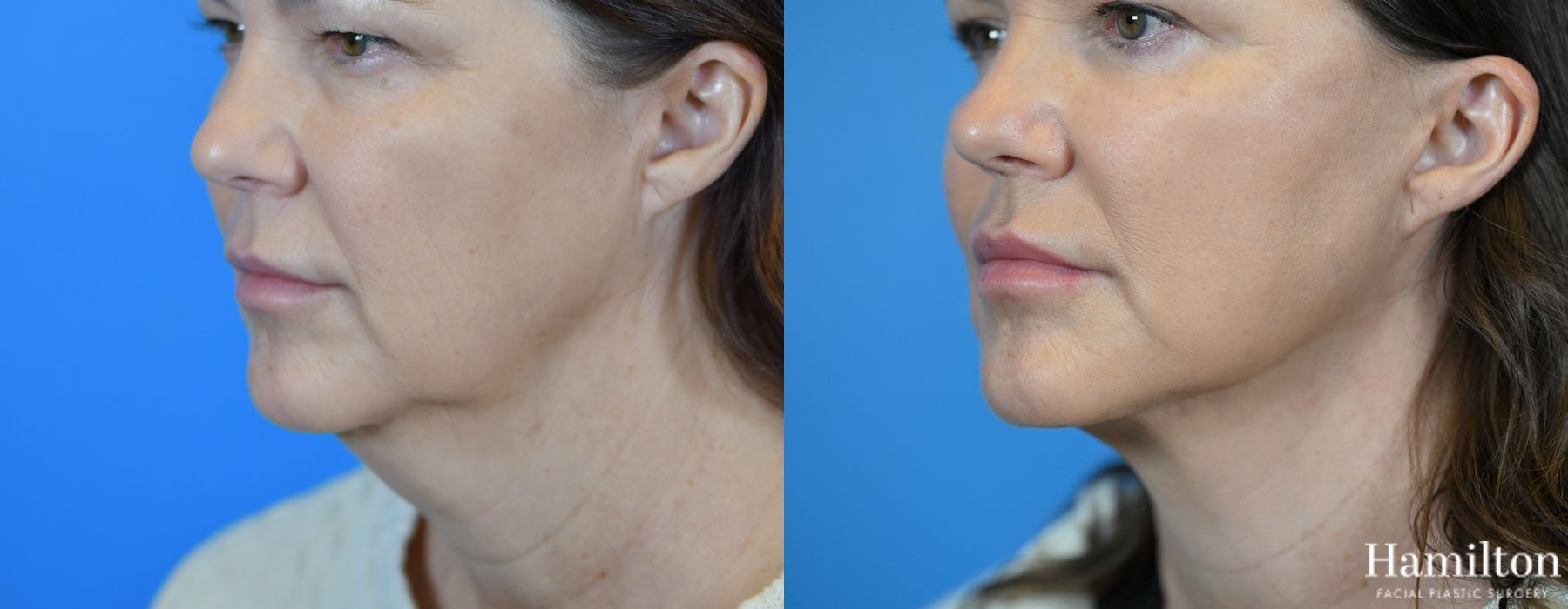 Before and after Facelift case 37254 - Angle 3