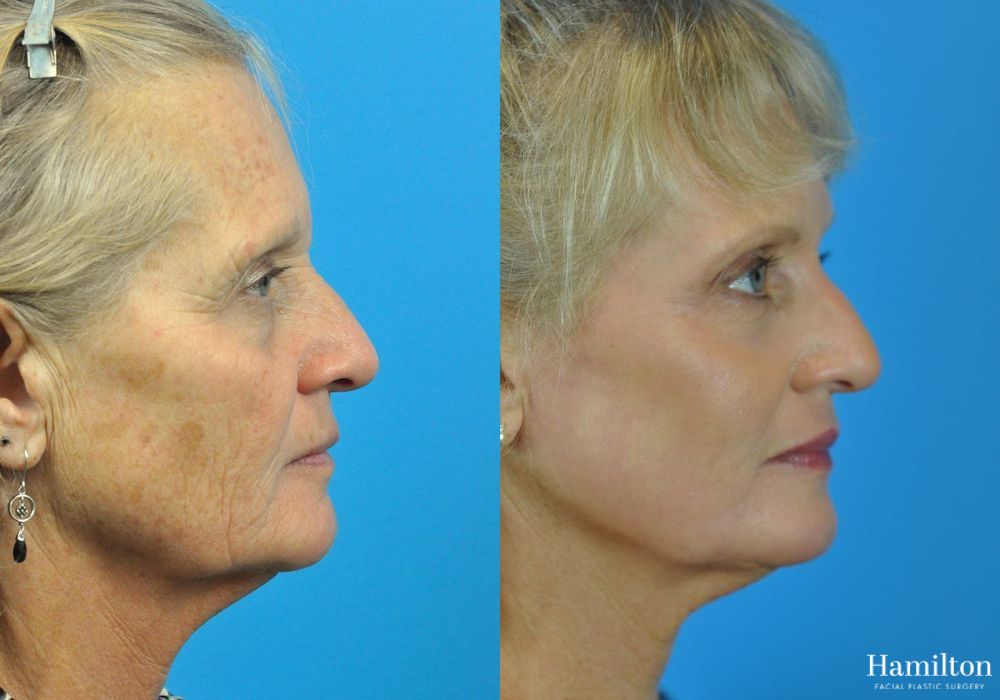 Before and after Laser - CO2 case 37091 - Angle 4