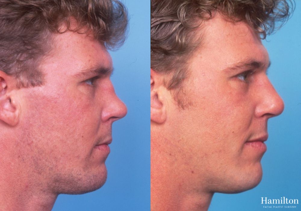 Before and after Rhinoplasty case 37341