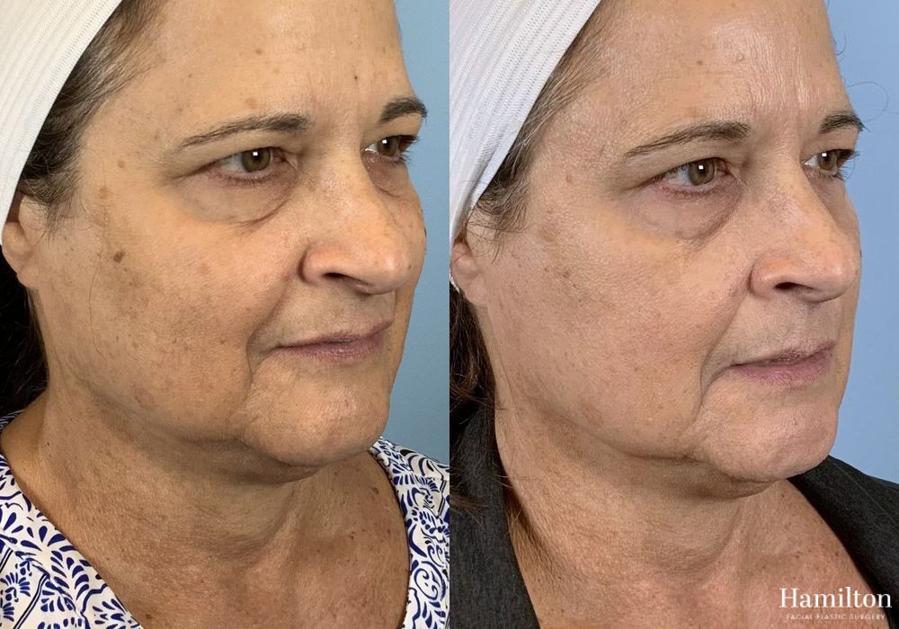 Before and after Laser - Broad Band Light (BBL) case 37228 - Angle 2