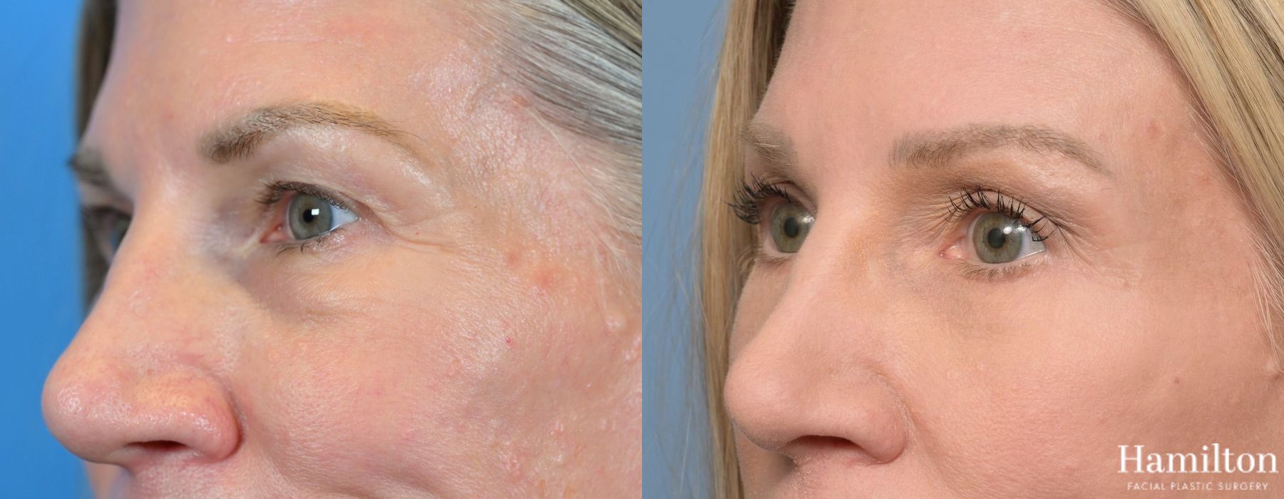 Before and after Blepharoplasty case 37257 - Angle 2