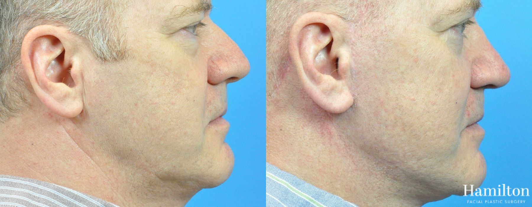 Before and after Rhinoplasty case 37264