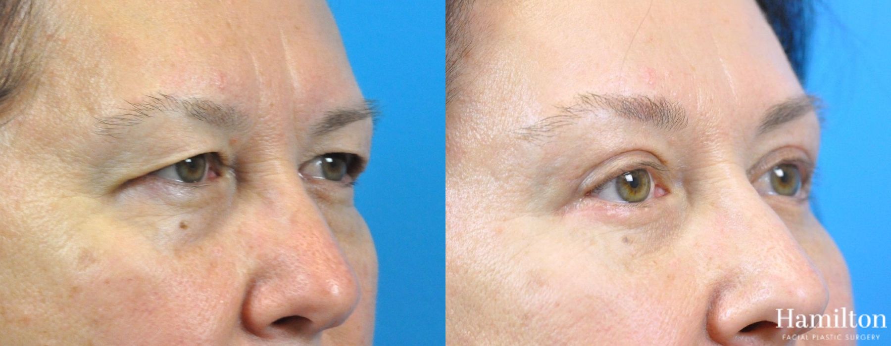 Before and after Blepharoplasty case 37308 - Angle 2