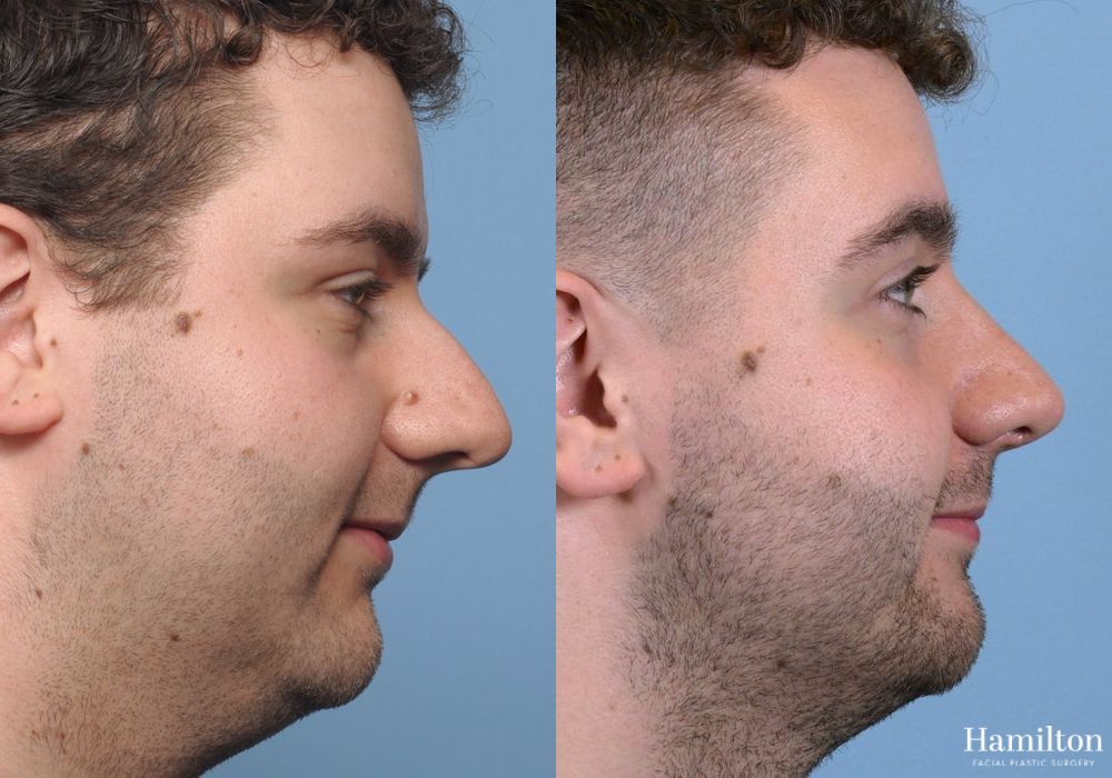 Before and after Rhinoplasty case 37236 - Angle 2
