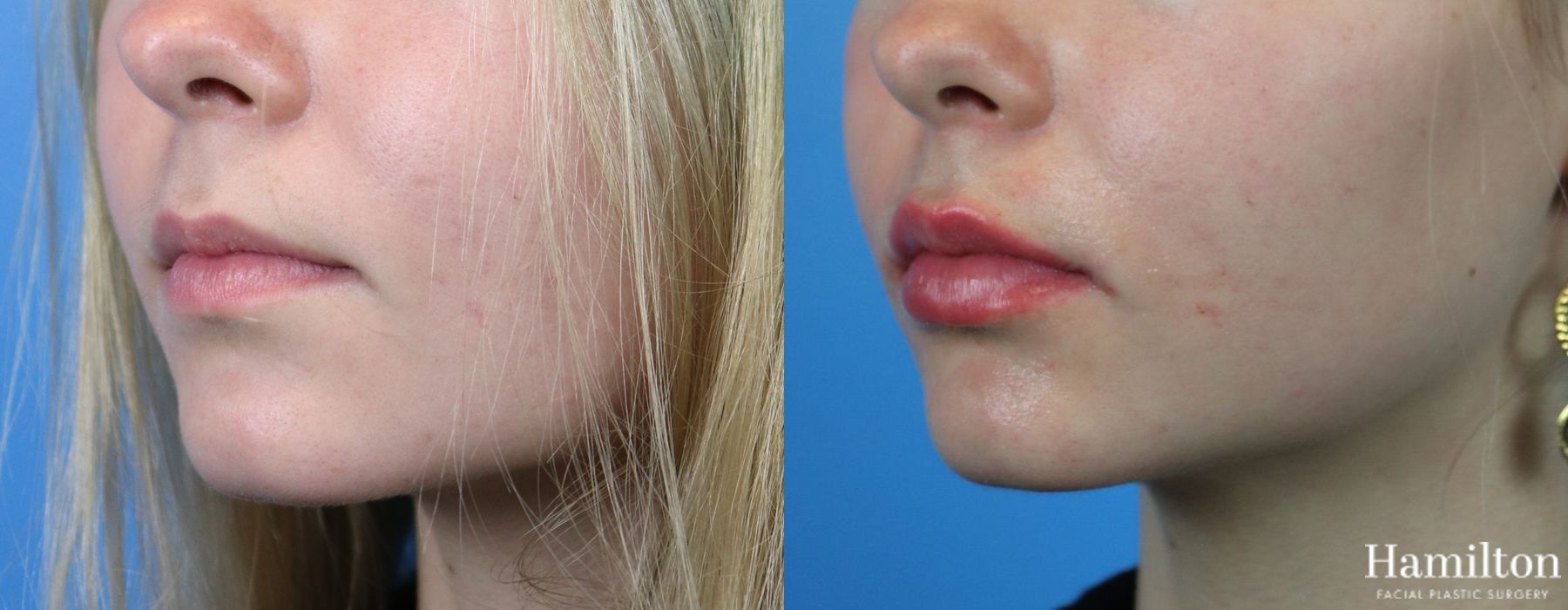 Before and after Fillers case 37084 - Angle 3