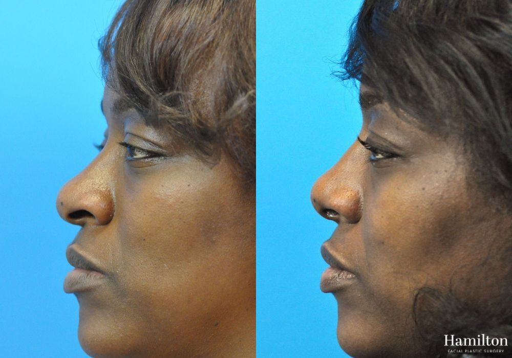 Before and after Rhinoplasty case 37295
