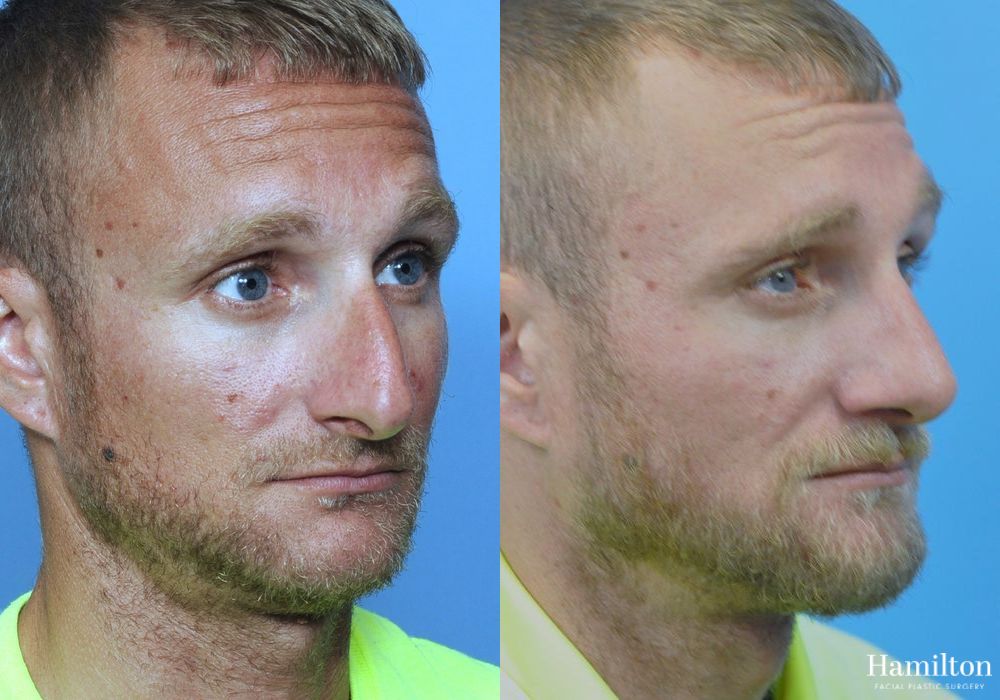 Before and after Rhinoplasty case 37303 - Angle 2