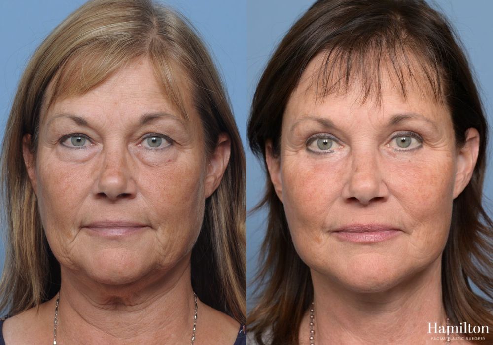 Before and after Facelift case 37258 - Angle 5