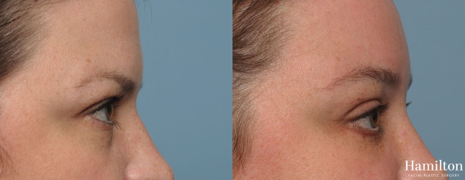 Before and after Brow Lift case 37086 - Angle 5