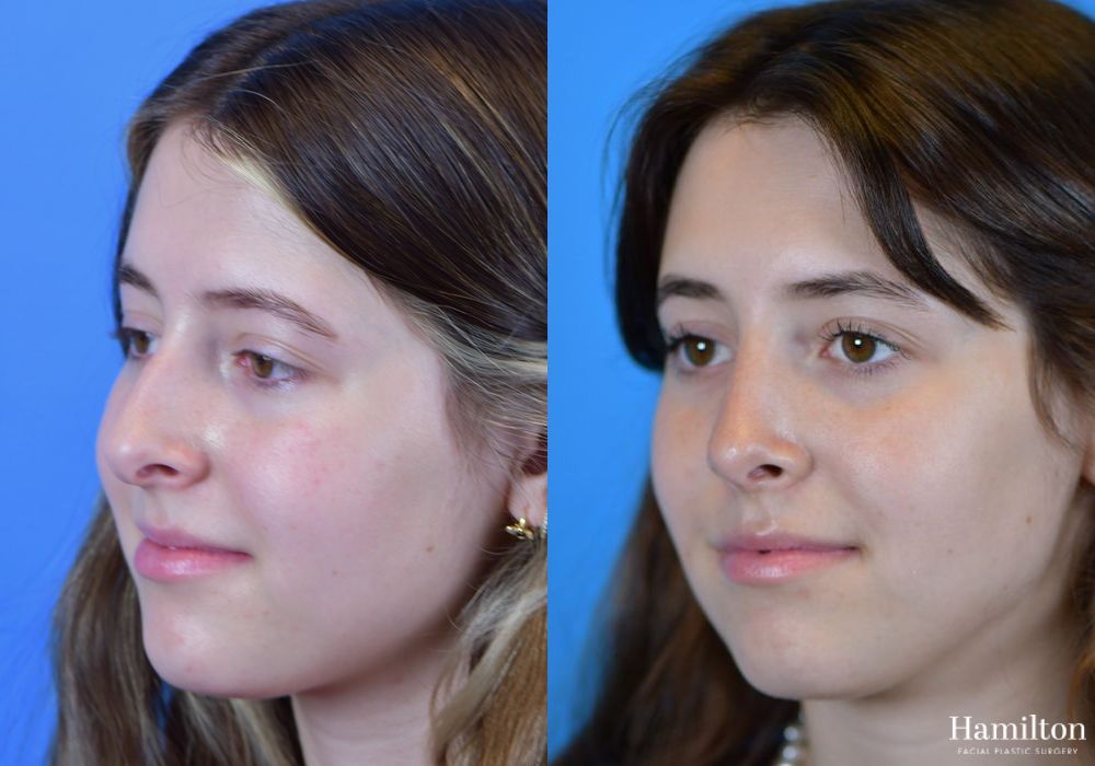 Before and after Rhinoplasty case 37336 - Angle 4