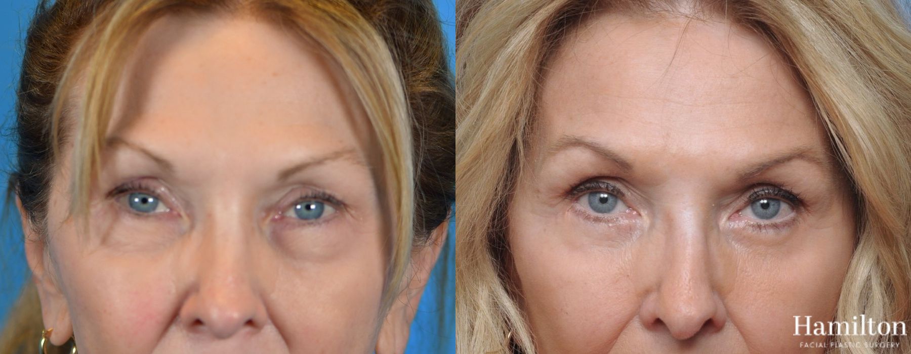 Before and after Blepharoplasty case 37129 - Angle 2