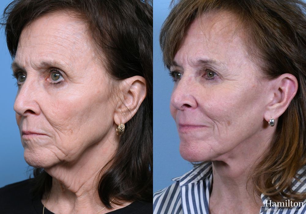 Before and after Facelift case 37338 - Angle 3