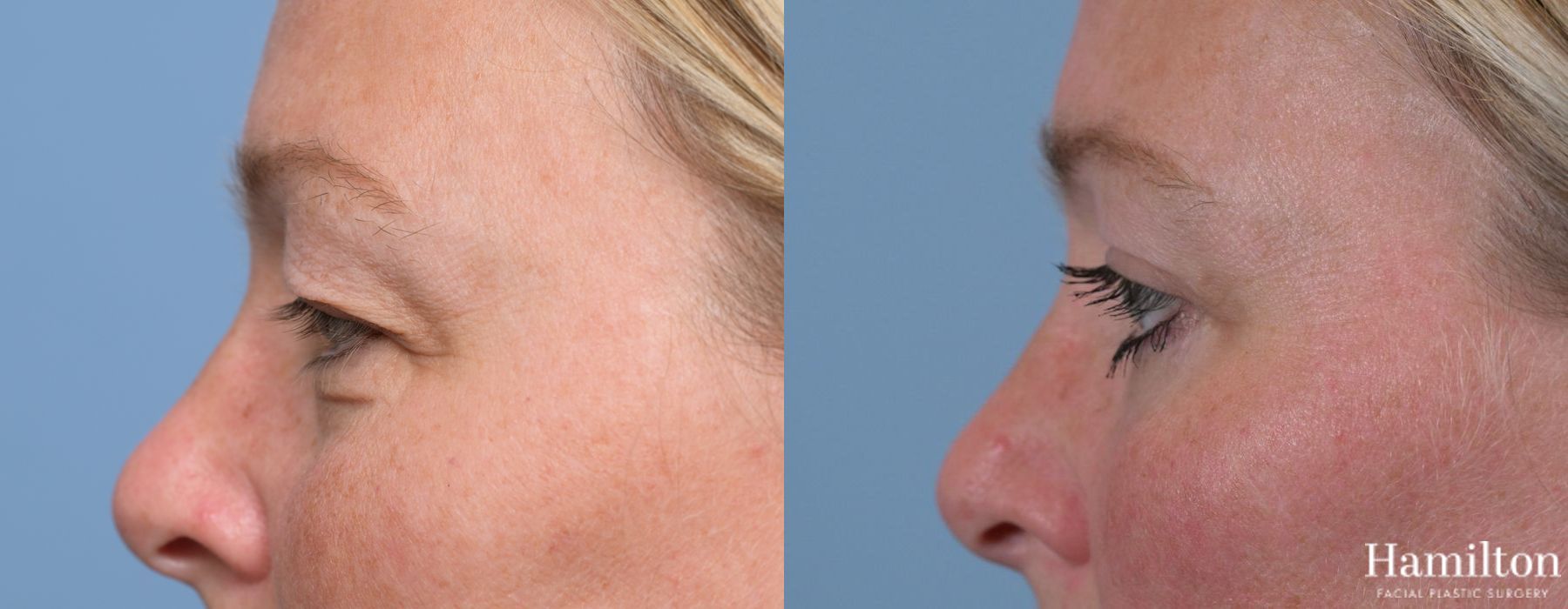 Before and after Blepharoplasty case 37119 - Angle 4