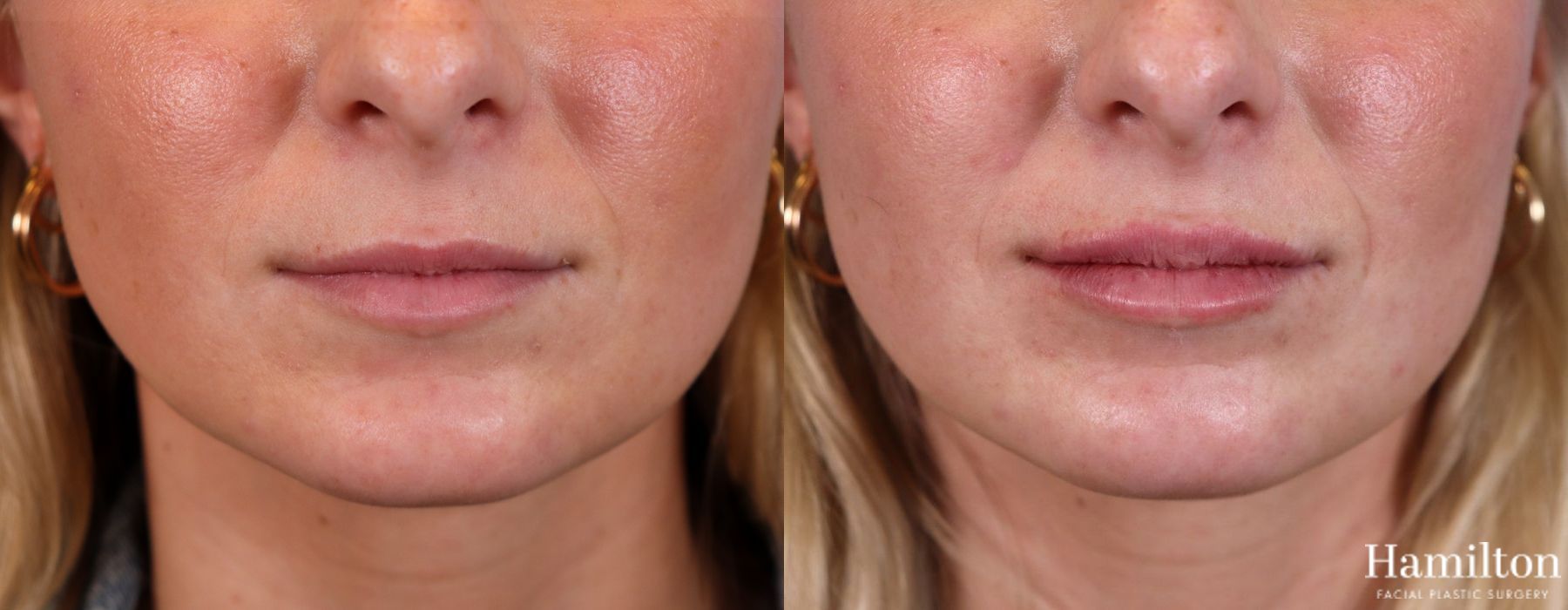 Before and after Lip Enhancement case 37173 - Angle 2