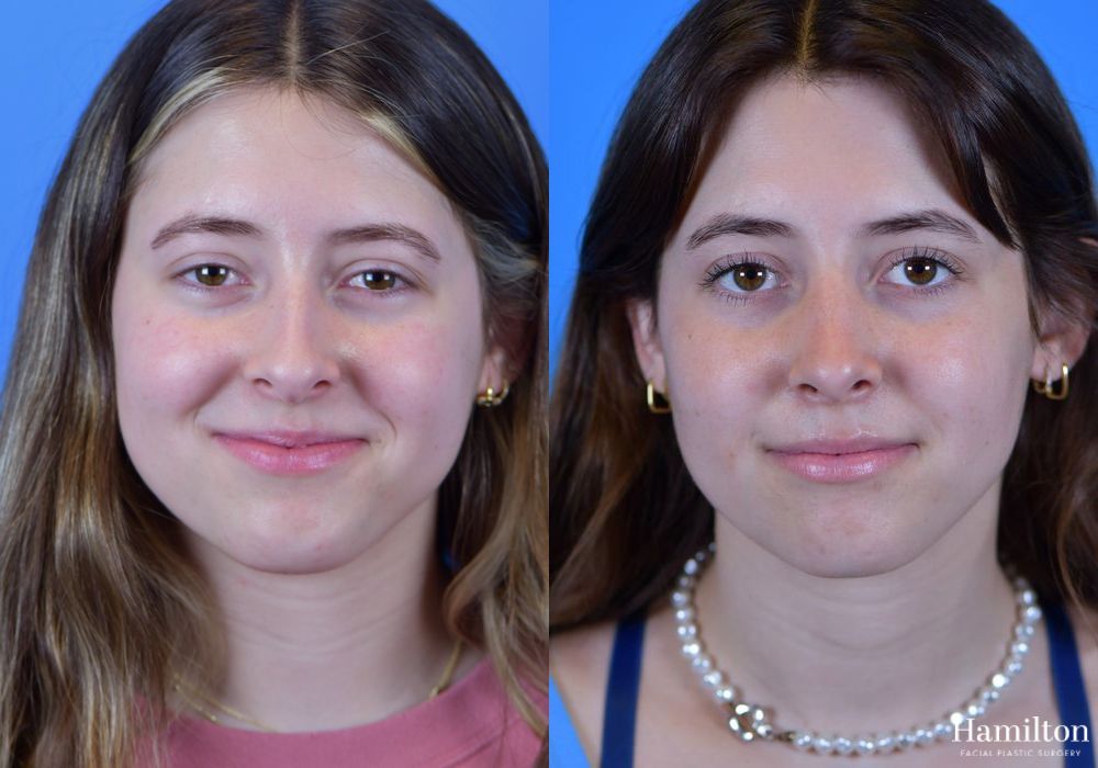 Before and after Rhinoplasty case 37336