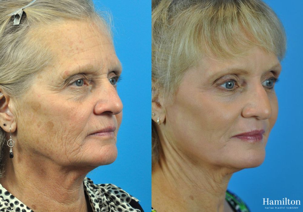 Before and after Laser - CO2 case 37091 - Angle 5