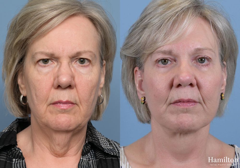 Before and after Brow Lift case 37139 - Angle 5