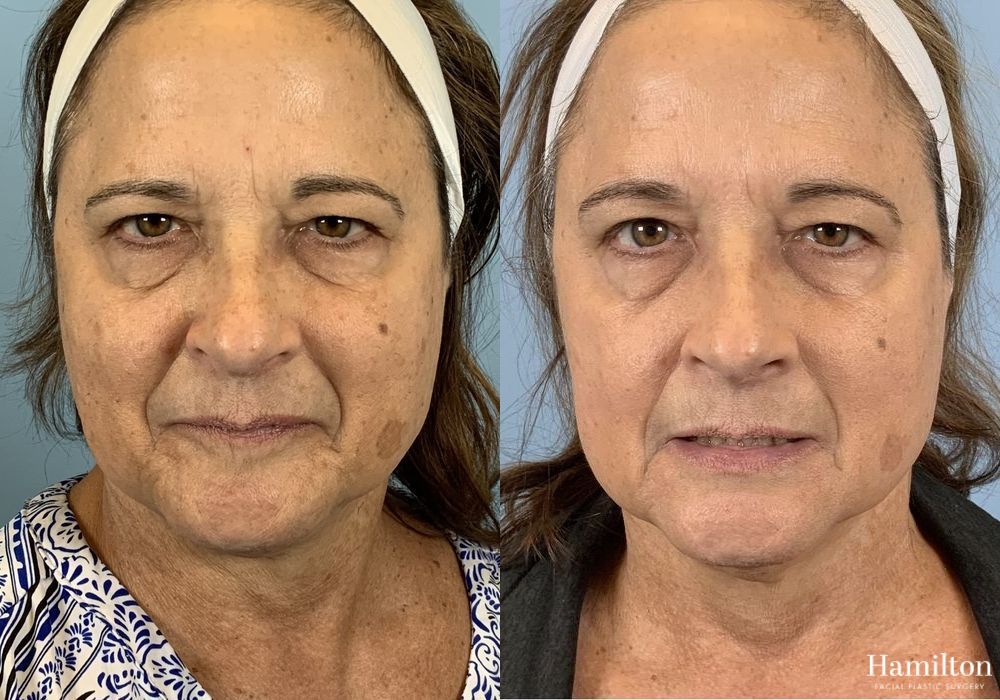 Before and after Laser - Broad Band Light (BBL) case 37228 - Angle 3