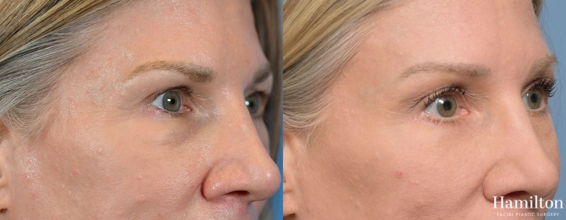 Before and after Blepharoplasty case 37257 - Angle 4