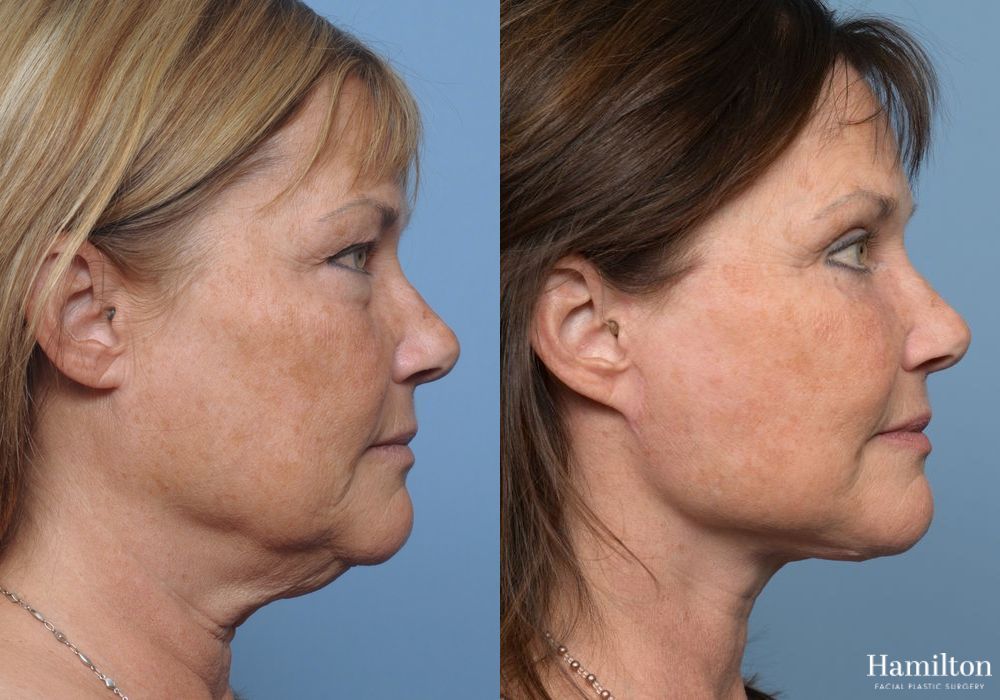 Before and after Facelift case 37258 - Angle 3