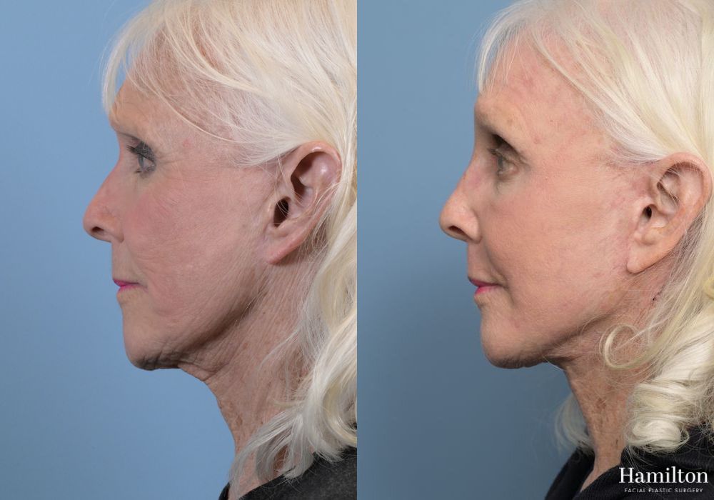 Before and after Facelift case 37281 - Angle 2
