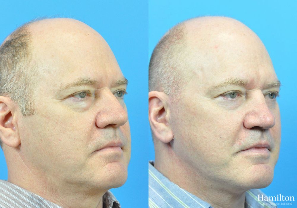 Before and after Rhinoplasty case 37264 - Angle 3