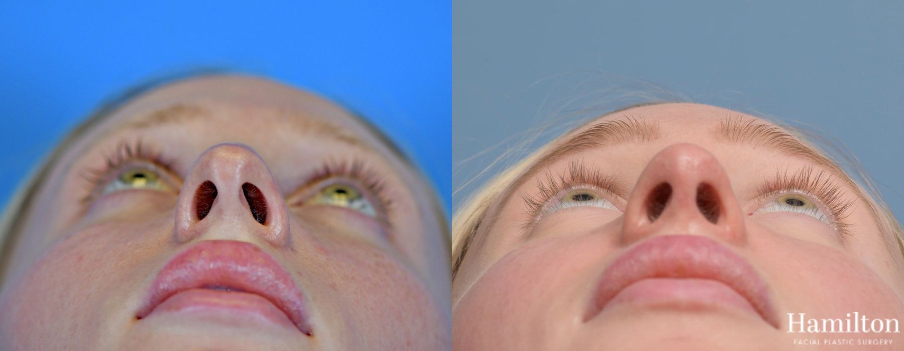 Before and after Rhinoplasty case 37157 - Angle 6
