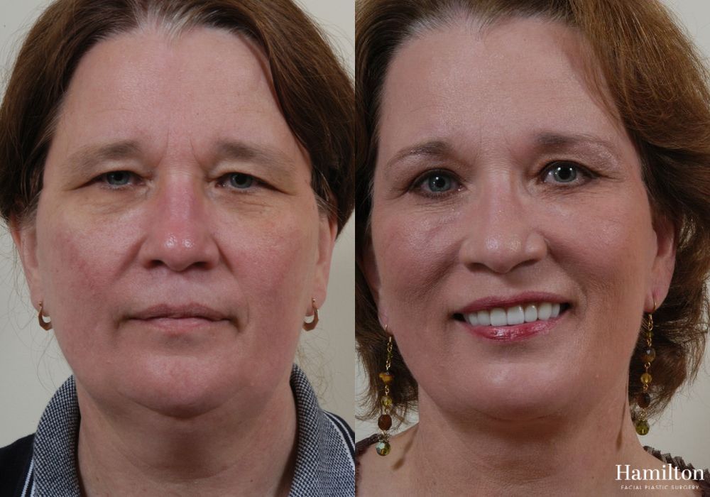 Before and after Facelift case 37265 - Angle 3